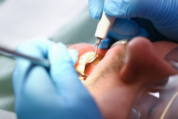 Best Emergency Treatment for Dental Infections or Abscesses in Montgomery, OH