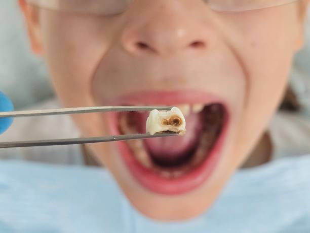 Best Emergency Tooth Extraction in Montgomery, OH